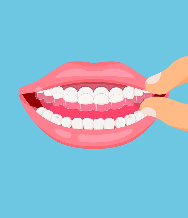benefits of invisalign min