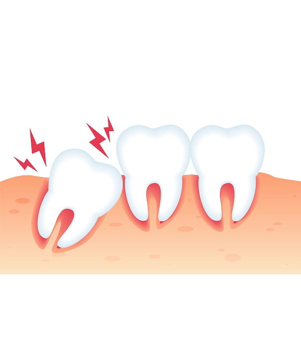 candidate for wisdom teeth min