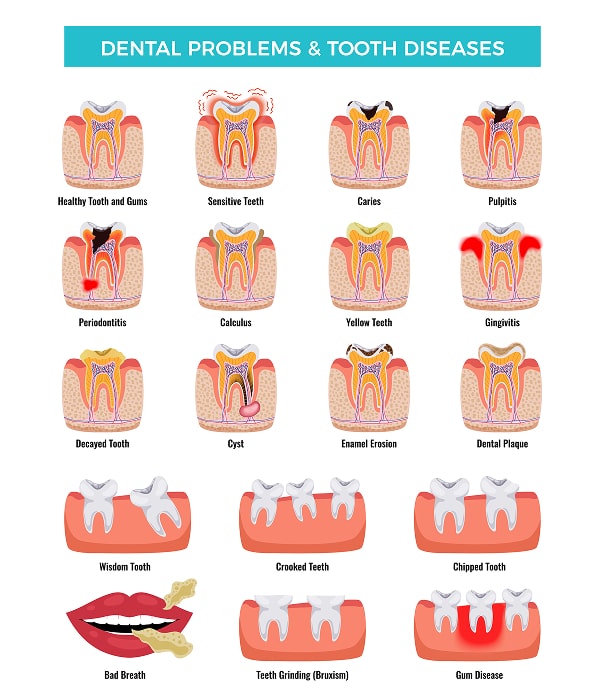 crowns and fillings replacement